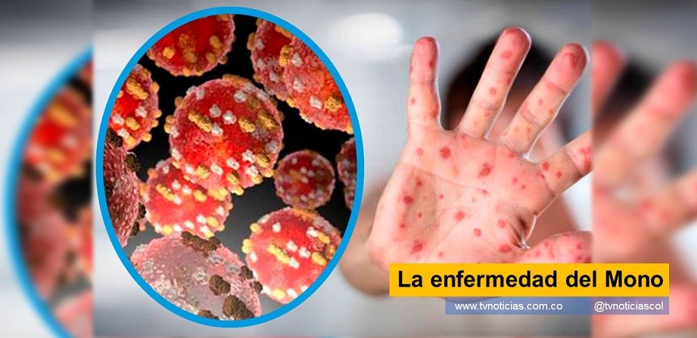 Aunque la viruela del mono es un problema de salud importante para las personas que viven en regiones endémicas de África, también es un problema de seguridad sanitaria mundial y se necesitan con urgencia intervenciones apropiadas y eficaces, como la vigilancia activa y el rastreo de contactos para evitar la identificación tardía de casos y la implementación de medidas de salud pública Un problema de seguridad sanitaria mundial es la afectación de la viruela del mono de acuerdo con las más recientes revelaciones de expertos La enfermedad del Mono tvnoticiascol www.tvnoticias.com.co