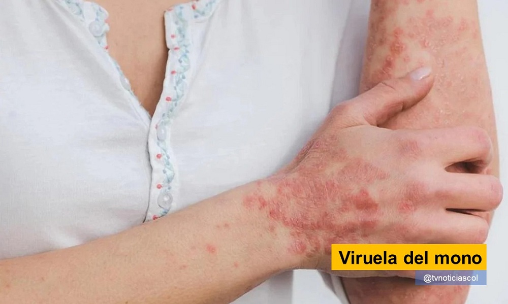 La prevención, única forma de repeler el ataque de la terrible enfermedad que ya llego a territorios como Colombia Viruela del mono tvnoticiascol ABC Viruela símica